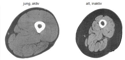 MRI images of the mid thigh of a healthy 25-year-old (left) and a healthy 75-year-old (right), which exhibits sarcopenia. Note the lower muscle mass (light grey), greater subcutaneous fat (dark grey) and increased intramuscular fat (dark grey lines) in the older participant’s leg. Adapted from [32].