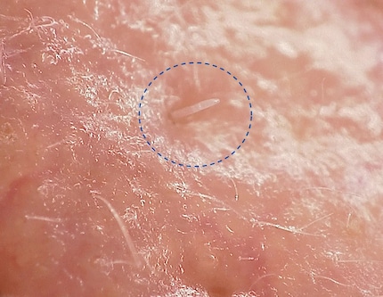 Milbe in Pore | Mikroskopische Aufnahme einer in einer Hautpore steckenden Demodex-folliculorum-Milbe.