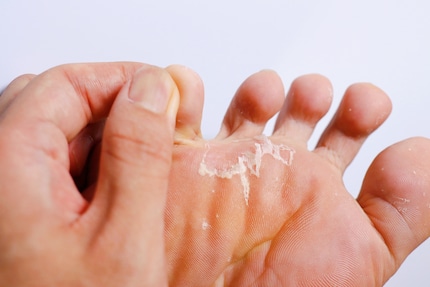 Athlete’s foot is unpleasant but relatively easy to treat.