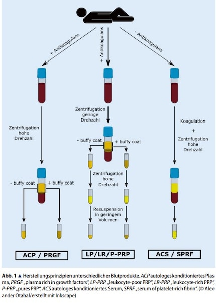 PRP is obtained from a person’s blood through one or two centrifugation steps in order to separate the components.