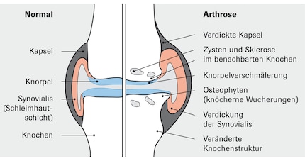 Osteoarthritis of the knee joint.