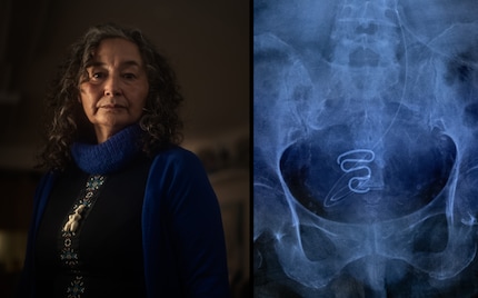 In 2019, Nanja Lyberth (left) told her story of suffering to a local newspaper in Nuuk - and got the scandal rolling. On the right, a photographed X-ray image of an implanted IUD.