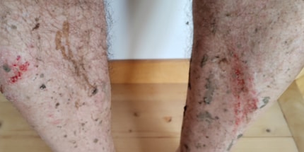 Not a great look: battered by my own pedals.