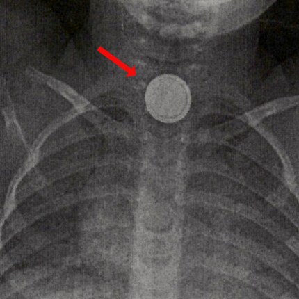 Lebensbedrohlicher Notfall: Röntgenbild einer Knopfbatterie in der Speiseröhre eines Kleinkindes.